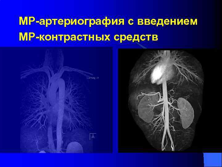 МР-артериография с введением МР-контрастных средств 