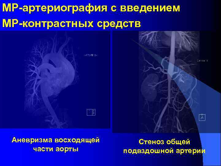 МР-артериография с введением МР-контрастных средств Аневризма восходящей части аорты Стеноз общей подвздошной артерии 