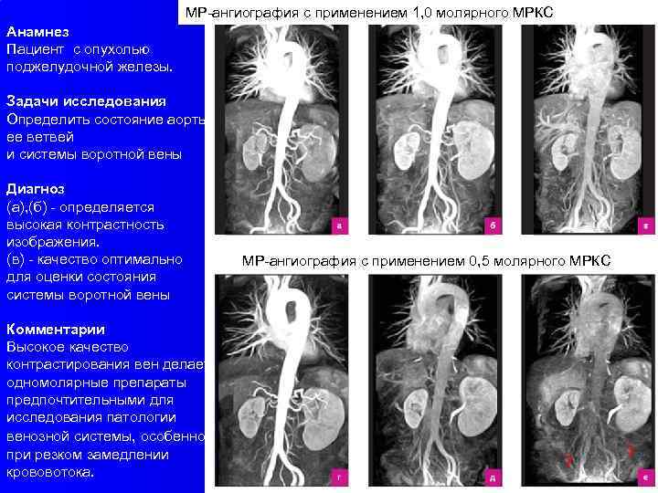 МР-ангиография с применением 1, 0 молярного МРКС Анамнез Пациент с опухолью поджелудочной железы. Задачи