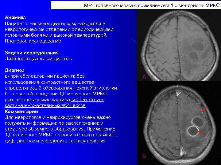 МРТ головного мозга с применением 1, 0 молярного МРКС Анамнез Пациент с неясным диагнозом,