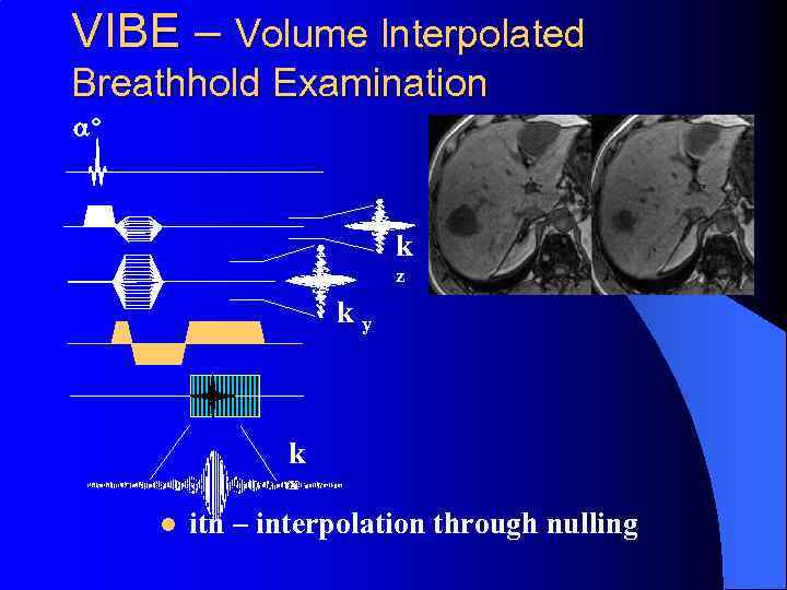 VIBE – Volume Interpolated Breathhold Examination a° k z k y k x l