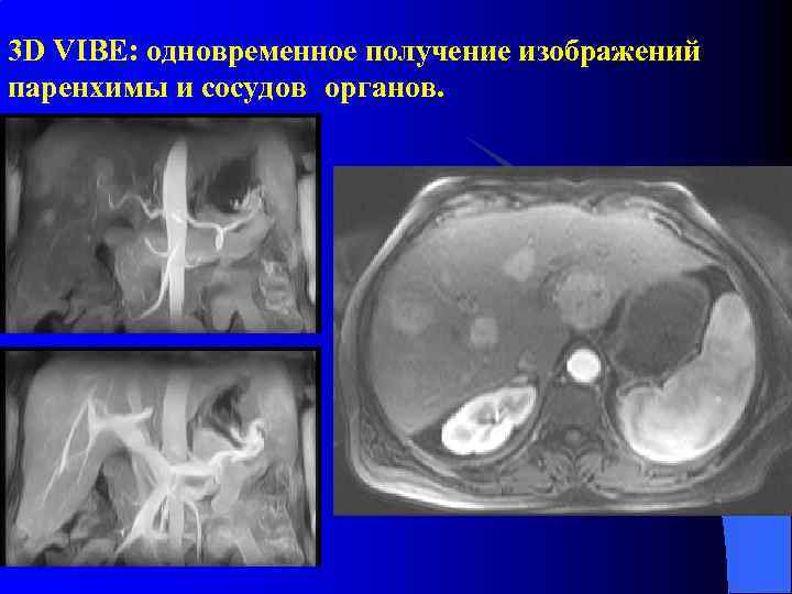 3 D VIBE: одновременное получение изображений паренхимы и сосудов органов. 