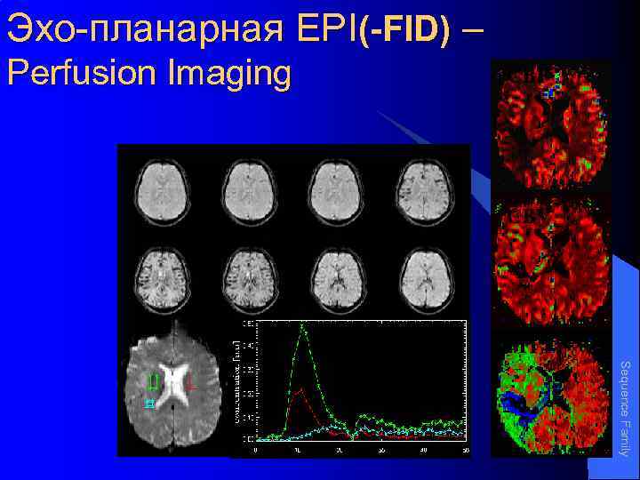 Эхо-планарная EPI(-FID) – Perfusion Imaging r. CBF r. CBV r. MTT Sequence Family 