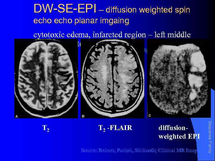 DW-SE-EPI – diffusion weighted spin echo planar imgaing cytotoxic edema, infarcted region – left