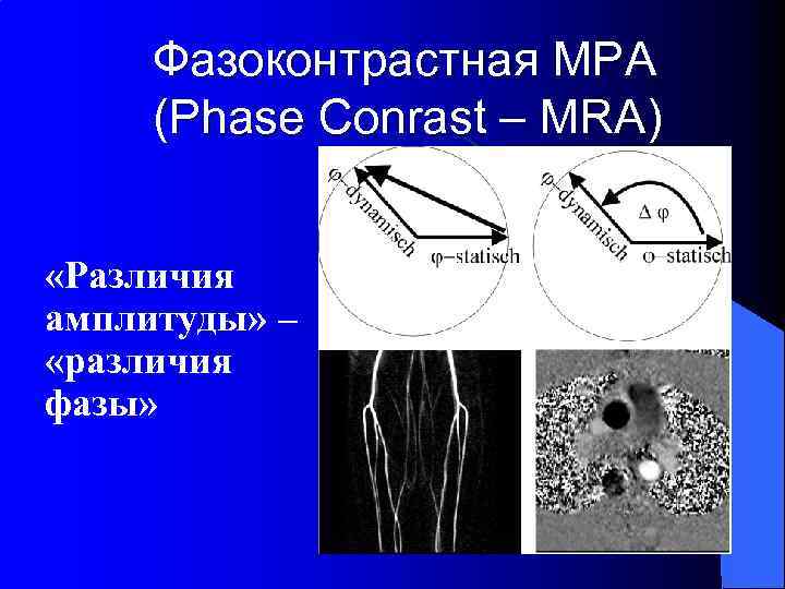 Фазоконтрастная МРА (Phase Conrast – MRA) «Различия амплитуды» – «различия фазы» 
