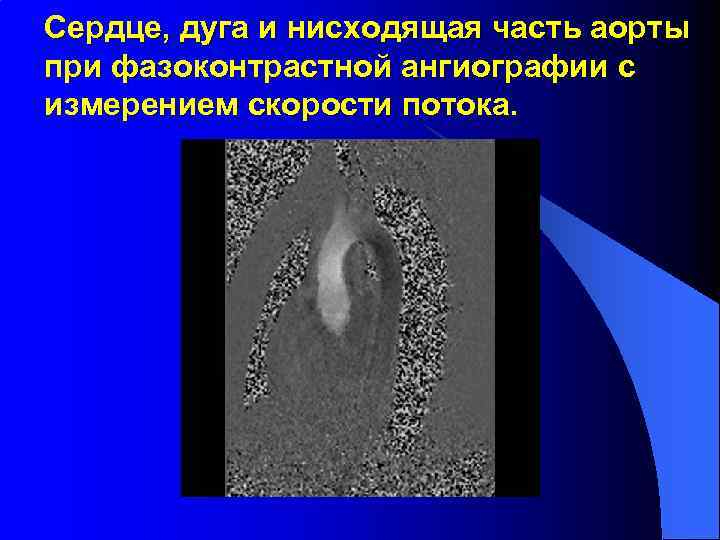 Сердце, дуга и нисходящая часть аорты при фазоконтрастной ангиографии с измерением скорости потока. 