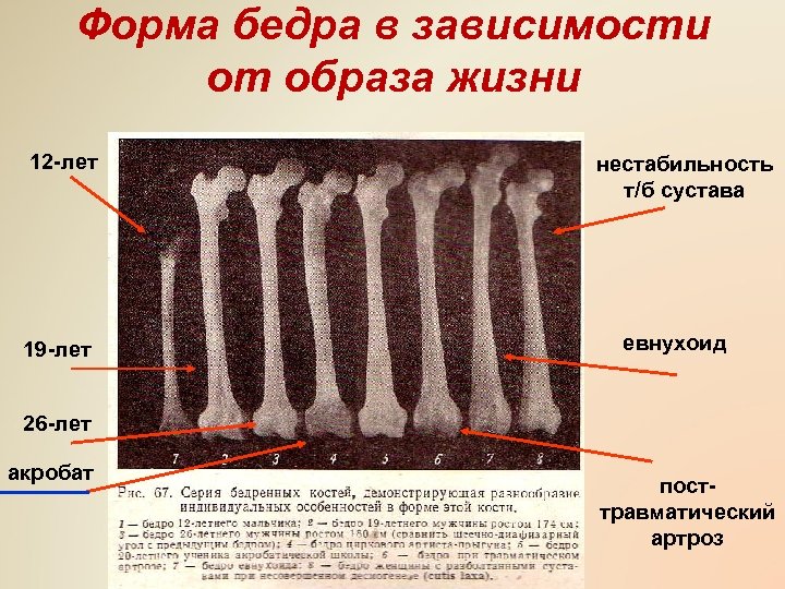 Форма бедра в зависимости от образа жизни 12 -лет 19 -лет нестабильность т/б сустава