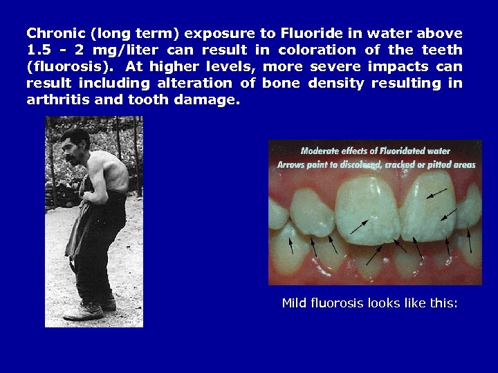 Chronic (long term) exposure to Fluoride in water above 1. 5 - 2 mg/liter