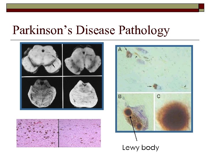 Parkinson’s Disease Pathology Lewy body 