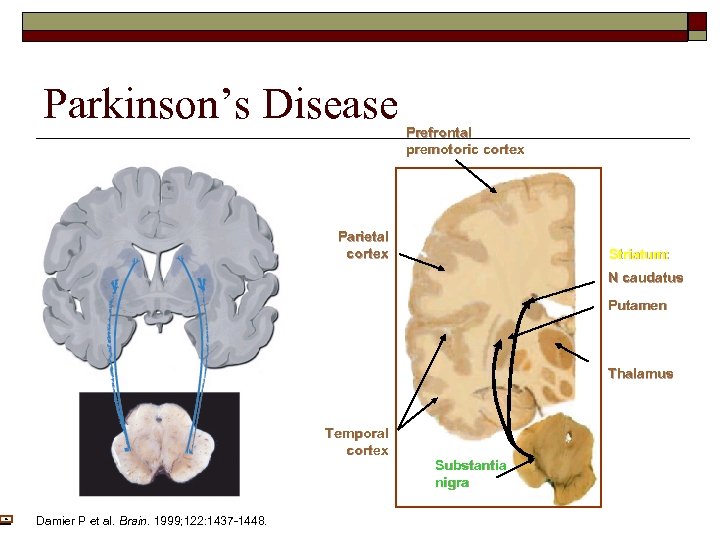 Parkinson’s Disease Prefrontal premotoric cortex Parietal cortex Striatum: N caudatus Putamen Thalamus Temporal cortex