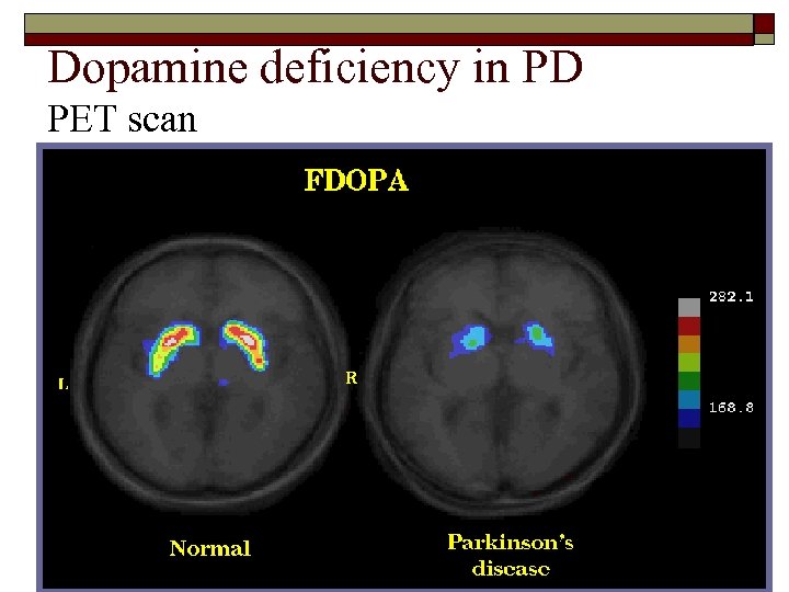 Dopamine deficiency in PD PET scan 