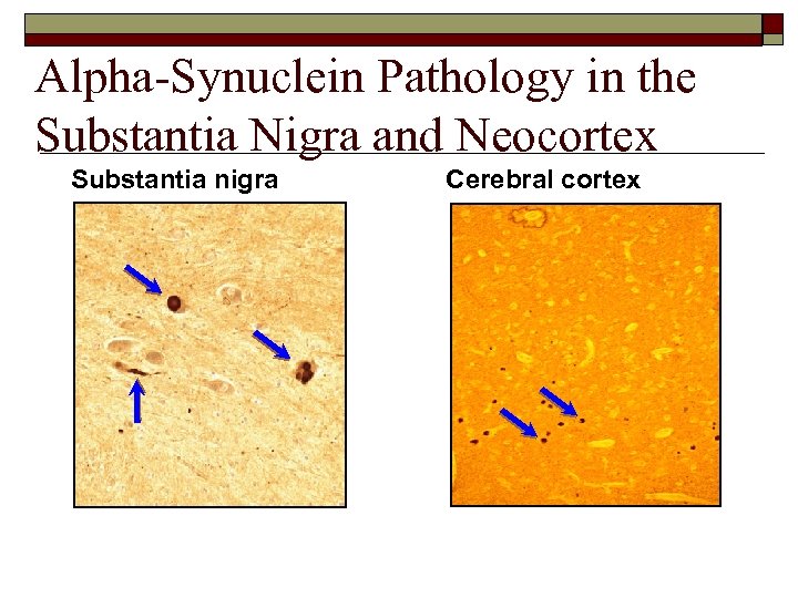 Alpha-Synuclein Pathology in the Substantia Nigra and Neocortex Substantia nigra Cerebral cortex 