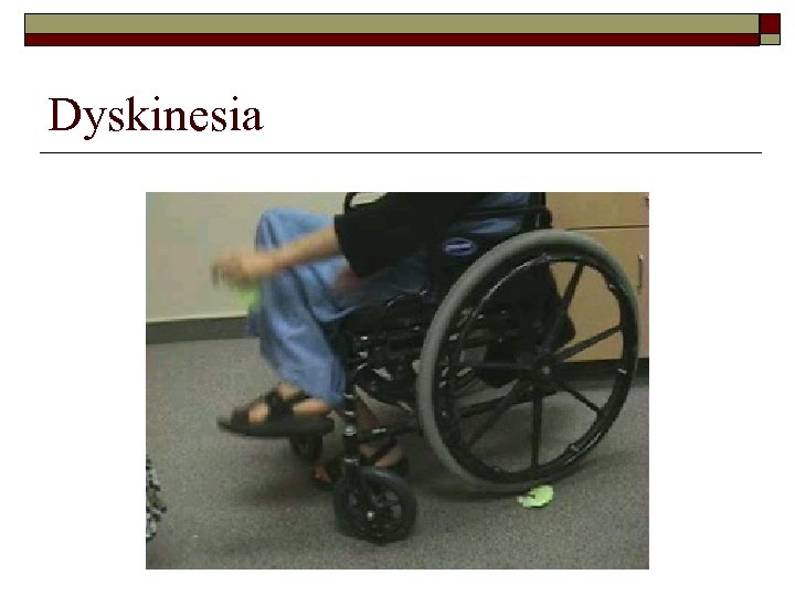 Dyskinesia 