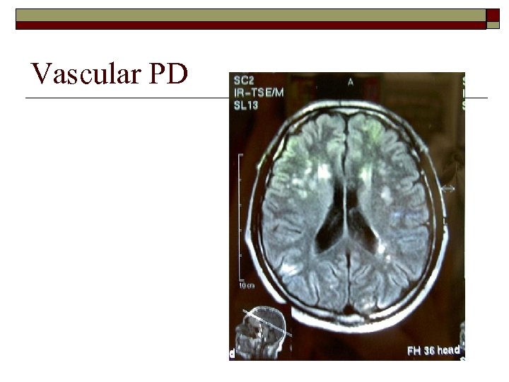 Vascular PD 