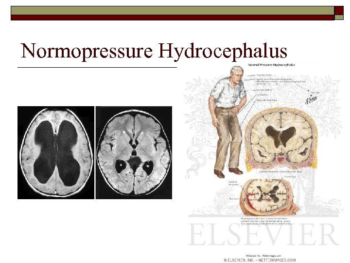 Normopressure Hydrocephalus 