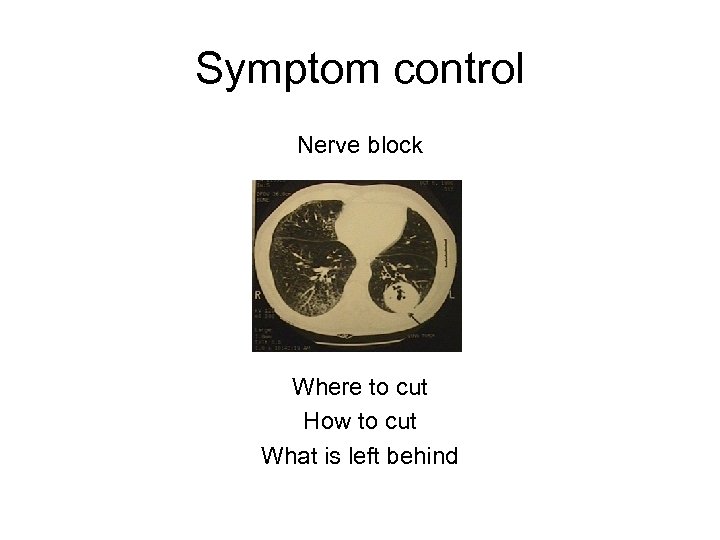 Symptom control Nerve block Where to cut How to cut What is left behind