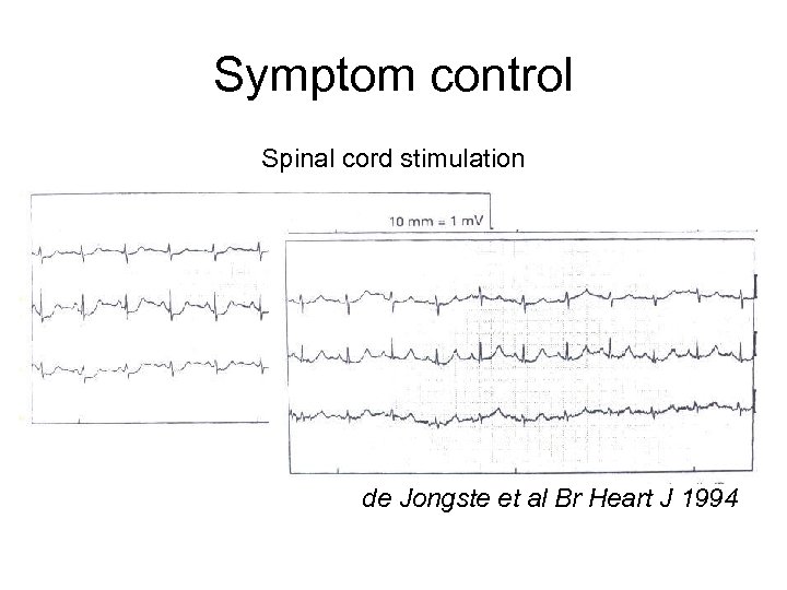Symptom control Spinal cord stimulation de Jongste et al Br Heart J 1994 