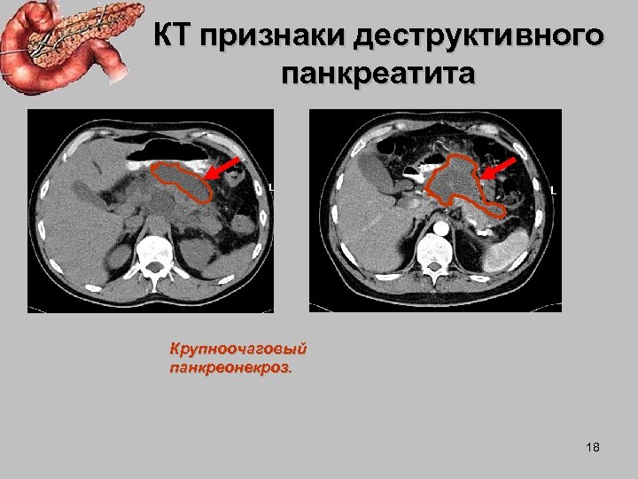 Кт признаки. Панкреонекроз поджелудочной железы кт. Деструктивный панкреатит поджелудочной железы. Острый деструктивный панкреатит кт. Псевдотуморозный панкреатит кт.