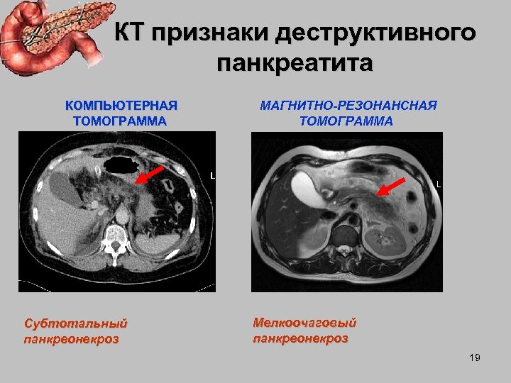 Кт картина острого панкреатита