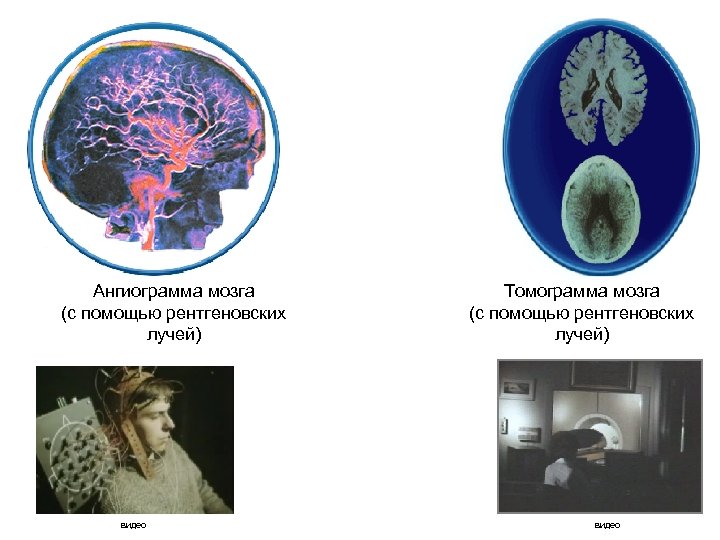 Ангиограмма мозга (с помощью рентгеновских лучей) видео Томограмма мозга (с помощью рентгеновских лучей) видео