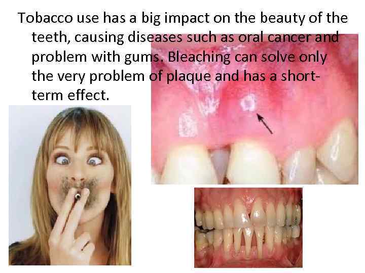 Tobacco use has a big impact on the beauty of the teeth, causing diseases