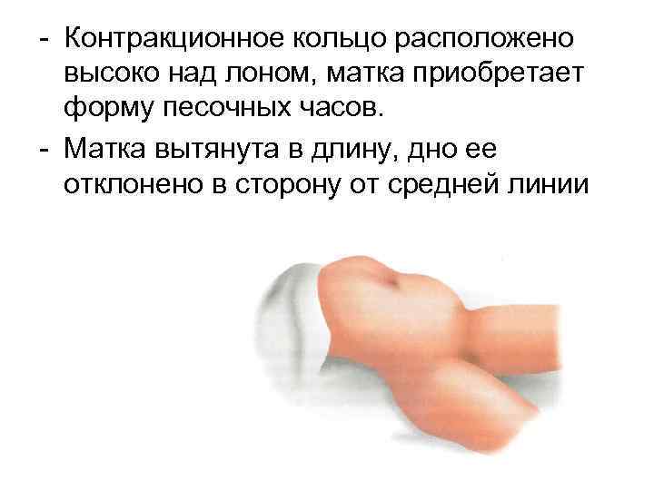 - Контракционное кольцо расположено высоко над лоном, матка приобретает форму песочных часов. - Матка