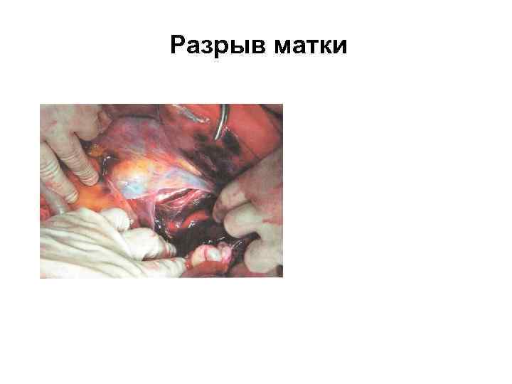 Разрыв матки 