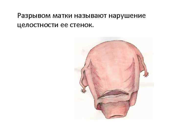 Разрывом матки называют нарушение целостности ее стенок. 