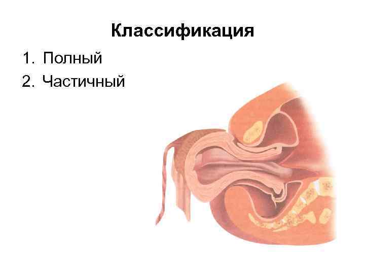 Классификация 1. Полный 2. Частичный 