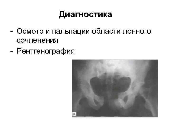 Гамак при разрыве лонного сочленения