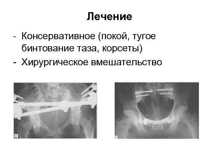 Лечение - Консервативное (покой, тугое бинтование таза, корсеты) - Хирургическое вмешательство 