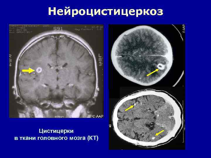 Нейроцистицеркоз Цистицерки в ткани головного мозга (КТ) 
