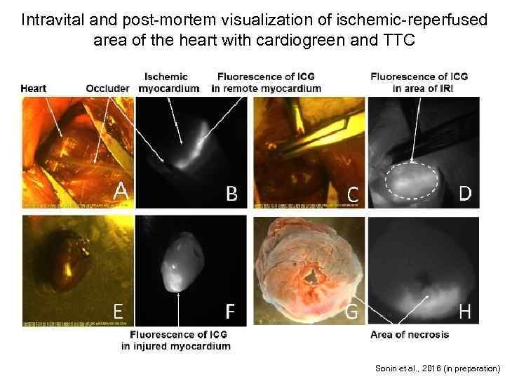 Intravital and post-mortem visualization of ischemic-reperfused area of the heart with cardiogreen and TTC