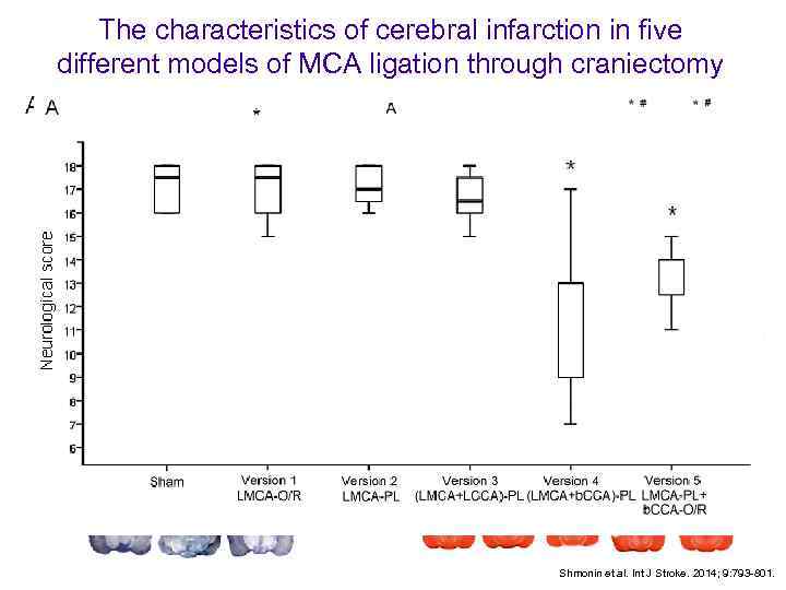 The characteristics of cerebral infarction in five different models of MCA ligation through craniectomy