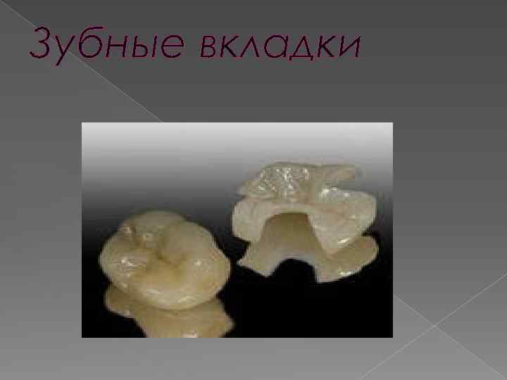 Зубные вкладки 