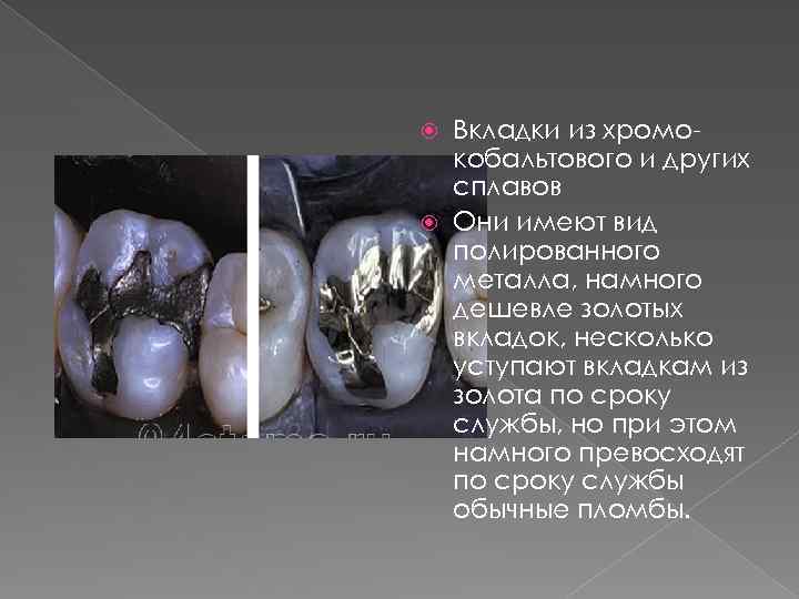 Вкладки из хромокобальтового и других сплавов Они имеют вид полированного металла, намного дешевле золотых