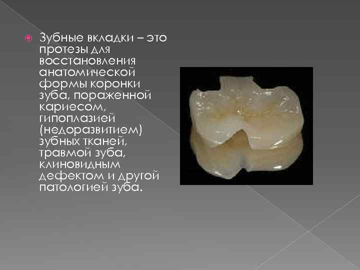  Зубные вкладки – это протезы для восстановления анатомической формы коронки зуба, пораженной кариесом,