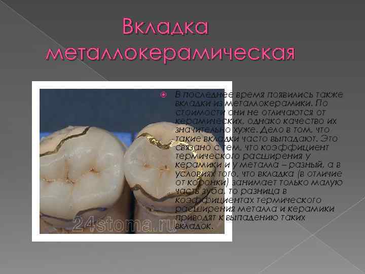 Вкладка металлокерамическая В последнее время появились также вкладки из металлокерамики. По стоимости они не