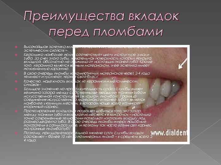 Преимущества вкладок перед пломбами Высочайшая эстетика вкладок из керамики, высокая стабильность эстетических свойств –