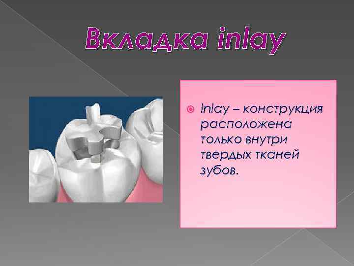 Вкладка inlay Inlay – конструкция расположена только внутри твердых тканей зубов. 