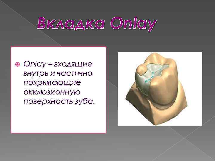 Вкладка Onlay – входящие внутрь и частично покрывающие окклюзионную поверхность зуба. 