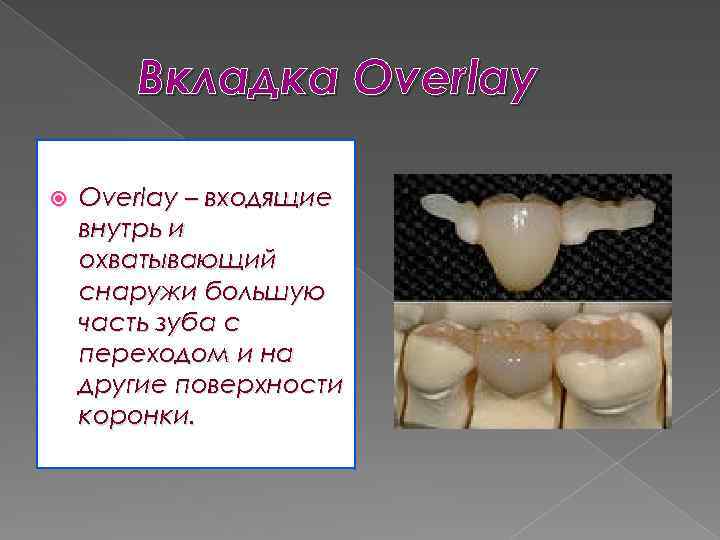 Вкладка Overlay – входящие внутрь и охватывающий снаружи большую часть зуба с переходом и