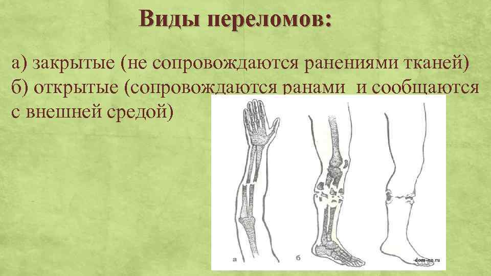 Виды переломов: а) закрытые (не сопровождаются ранениями тканей) б) открытые (сопровождаются ранами и сообщаются