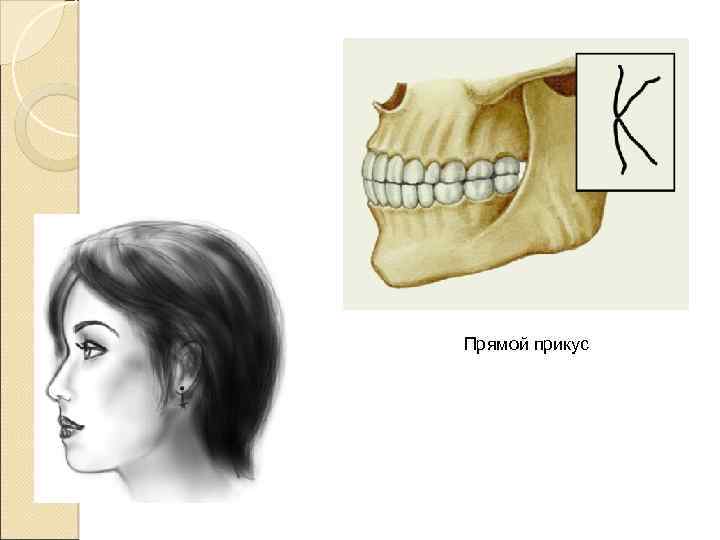 Прямая окклюзия