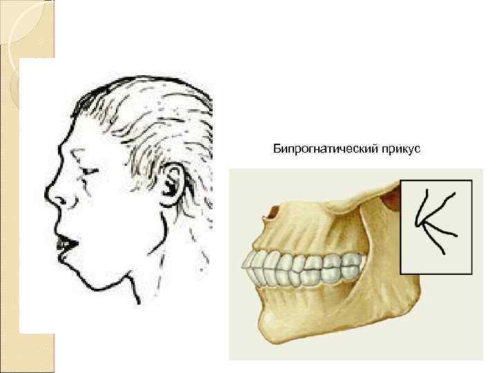 Опистогнатический прикус картинки