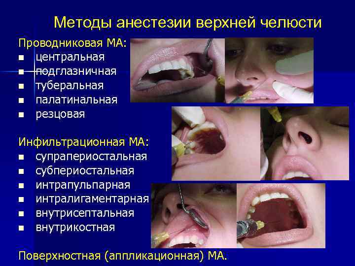 Методы анестезии верхней челюсти Проводниковая МА: n центральная n подглазничная n туберальная n палатинальная