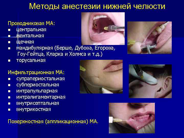 Методы анестезии нижней челюсти Проводниковая МА: n центральная n ментальная n щечная n мандибулярная