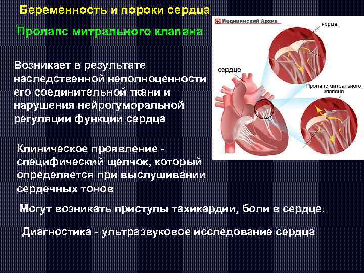Беременность и пороки сердца Пролапс митрального клапана Возникает в результате наследственной неполноценности его соединительной