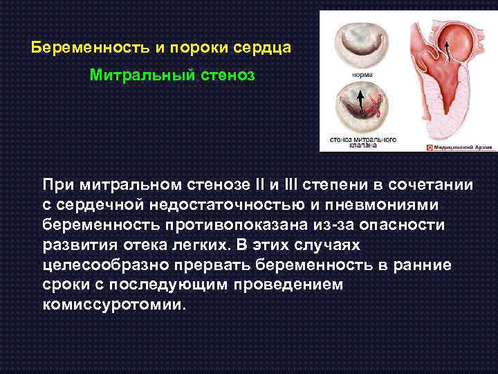 Беременность и пороки сердца Митральный стеноз При митральном стенозе II и III степени в