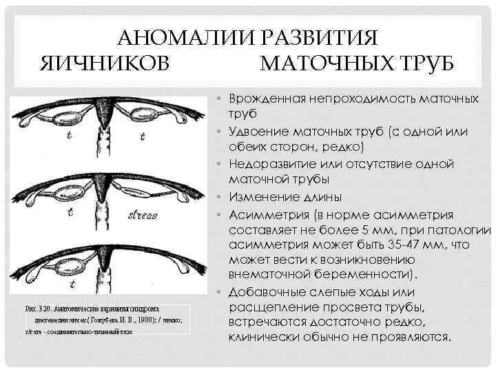 АНОМАЛИИ РАЗВИТИЯ ЯИЧНИКОВ МАТОЧНЫХ ТРУБ • Врожденная непроходимость маточных труб • Удвоение маточных труб